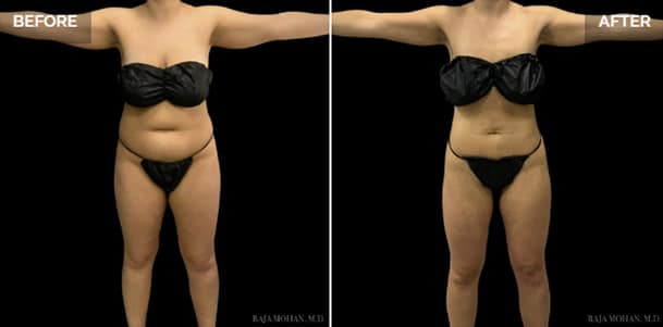 Liposuction Dallas, Cost and See Photos