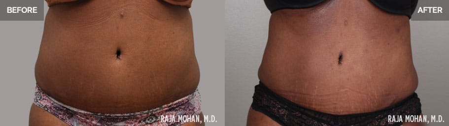 360 Liposuction Before and After Geo City