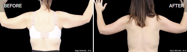 Arm lift before and after scar