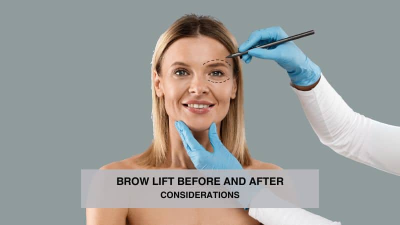 Brow Lift Before and After Considerations