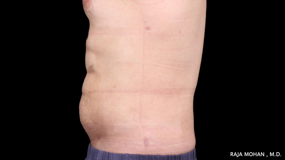 High Definition Lipo Patient Plastic Surgeon Dallas