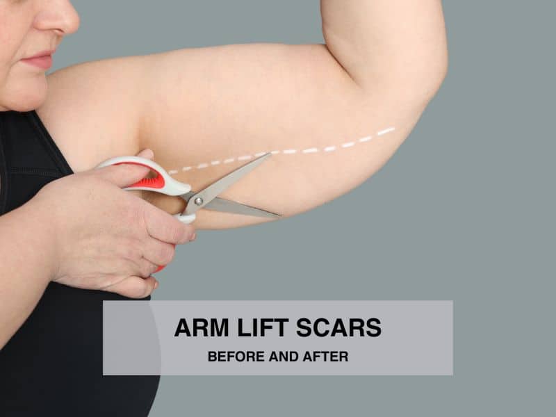 arm lift scars before and after