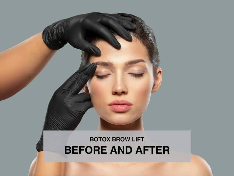 botox brow lift before and after