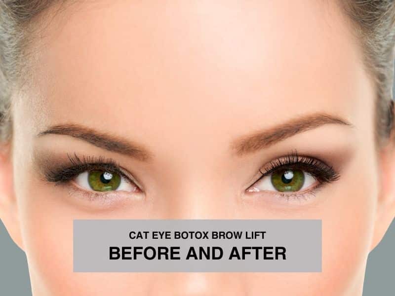 cat eye botox brow lift before and after