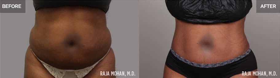 High Definition Liposuction Before and After Geo City