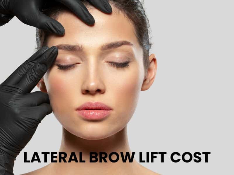 lateral brow lift cost