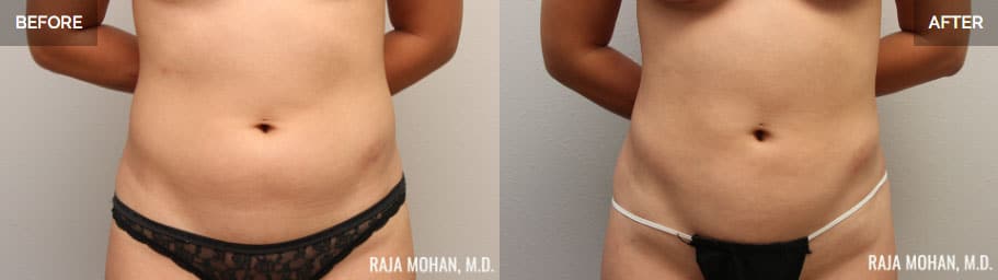 Liposuction Before and After Geo City