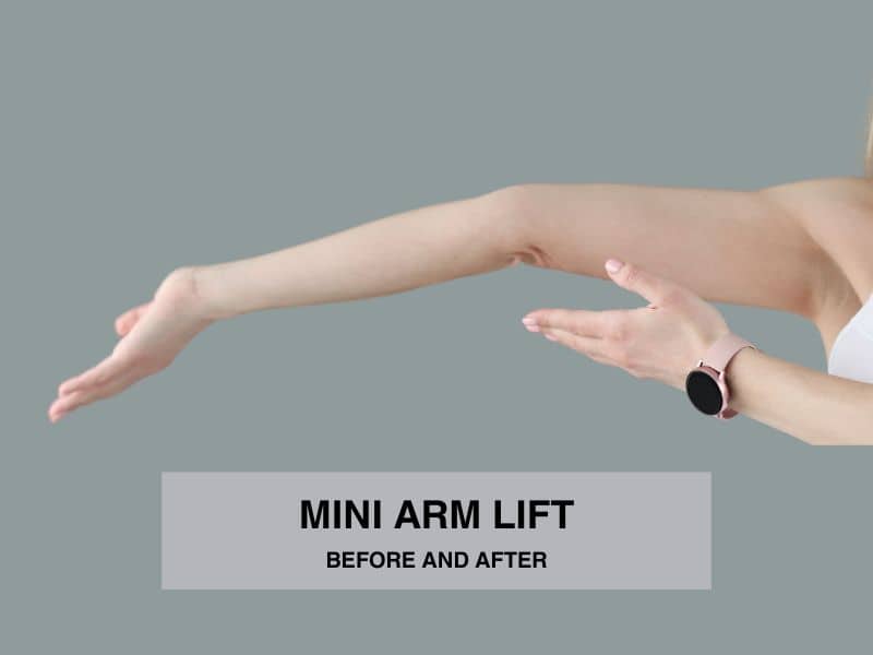 mini arm lift before and after