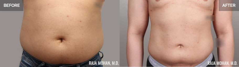 Tumescent Liposuction Before and After Geo City